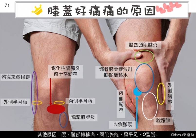 但摸不到找不到 膝盖痛的原因 位置区分- 膝盖痛前侧 股四头肌肌腱炎