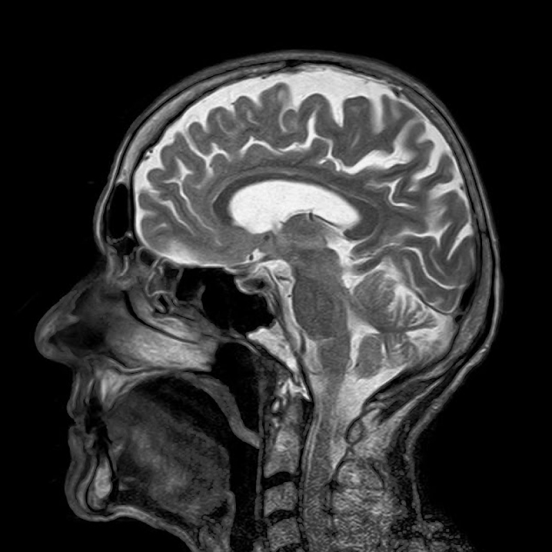 核磁共振测量大脑体积  用精密仪器测量受试者大脑后,bj&oslas