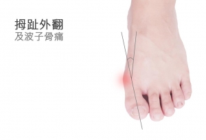 【傷患】挑跑鞋前注意 後跟高度影響拇趾外翻