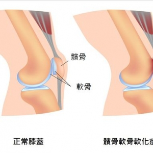 六種保護膝蓋的運動