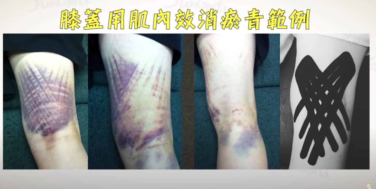 知識 打破對於養傷的認知 腳扭到後你應該趕快做這三件事 文章 運動筆記