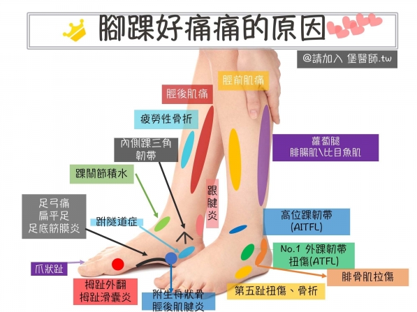 腳踝扭傷拉傷 腳踝痛怎麼辦 原因與治療 網誌 跑步筆記