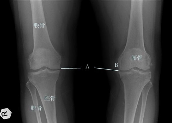 【登山醫學】膝關節的日常保健