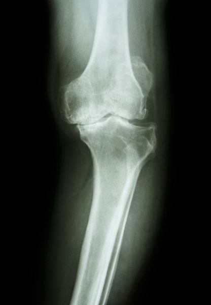 【書摘】《5分鐘走路治痛法》－退化性膝關節炎是可治癒的！重點在於不放棄