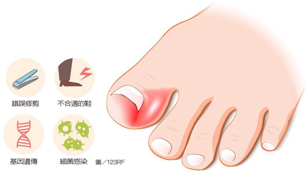 【知識】痛！指甲長進肉 錯誤修剪、穿錯鞋