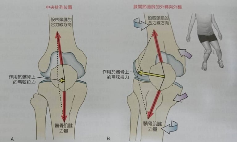 髕骨外翻