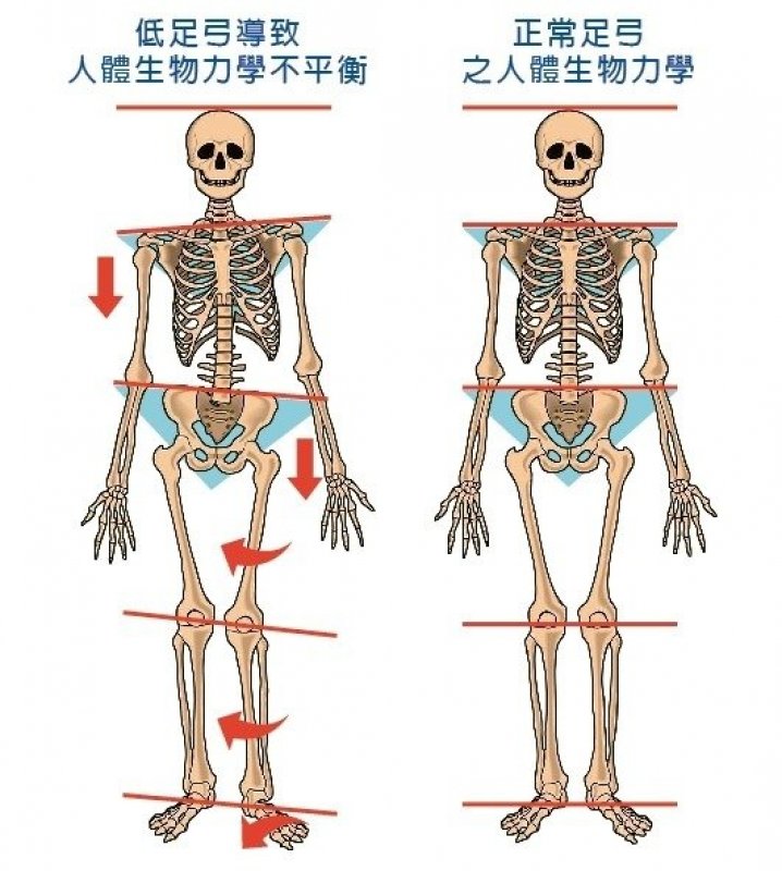 左為足弓過低導致足體內旋，使脛骨、膝蓋、股骨和髖關節連帶往內轉，同側骨盆與對側肩...