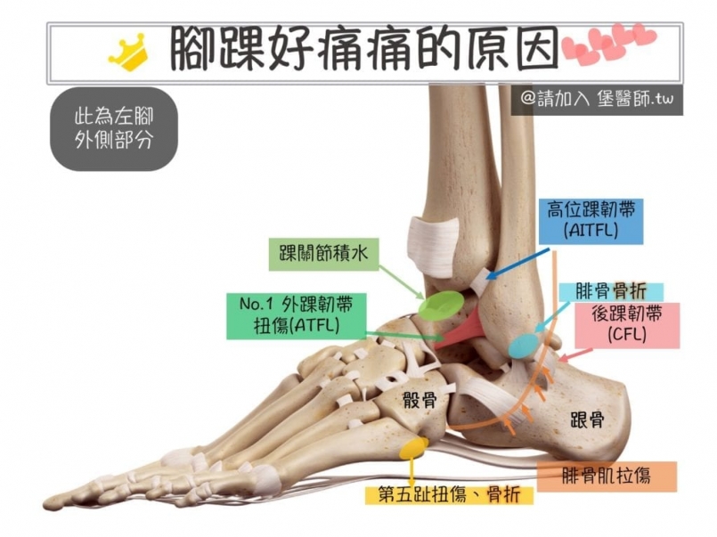 堡醫師專欄 腳踝扭傷拉傷 腳踝痛怎麼辦 原因與治療 運動筆記