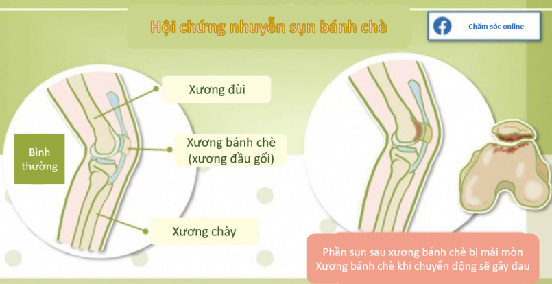 Các phương pháp điều trị nhuyễn sụn xương bánh chè