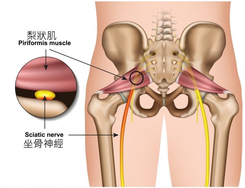 【筆記志療師】走路內八外八只是姿勢習慣問題？可能是梨狀肌凸搥了