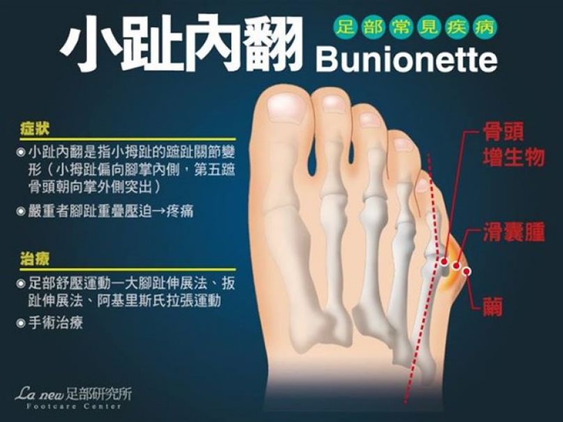 健走路跑常見9項足病症秘訣大公開 文章 運動筆記