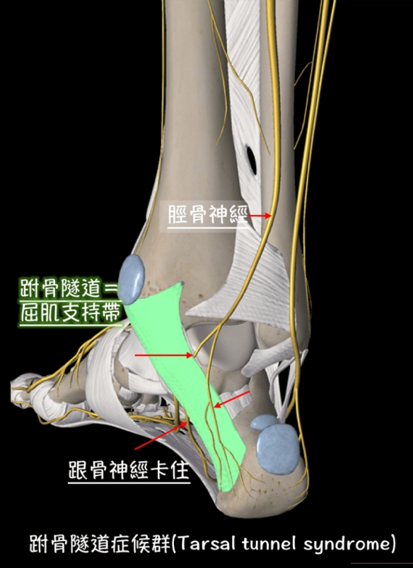 跗骨隧道症