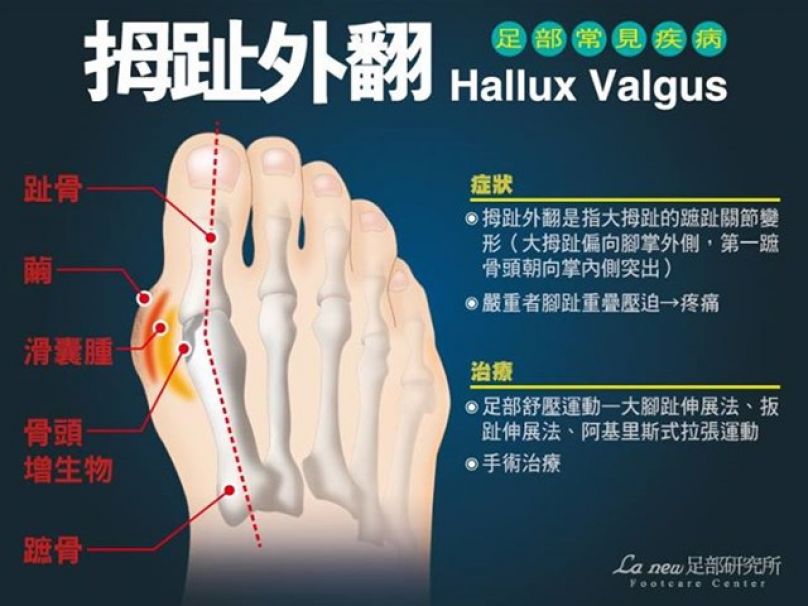 健走路跑常見9項足病症秘訣大公開 文章 運動筆記