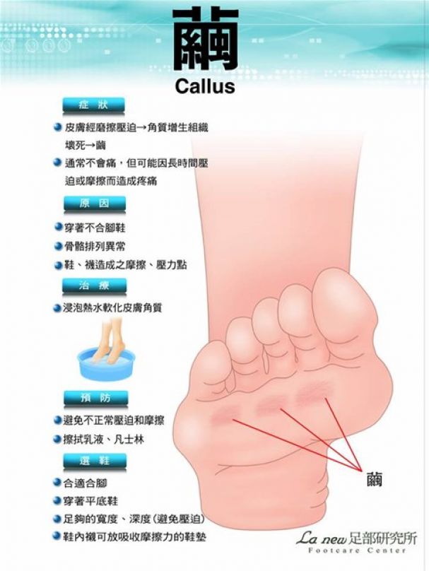 健走路跑常見9項足病症秘訣大公開 文章 運動筆記