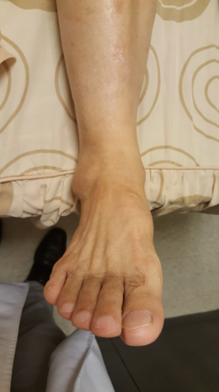 【傷痛防護】淺談內踝三角韌帶勞損：十年舊傷如何造就急性內踝疼痛？