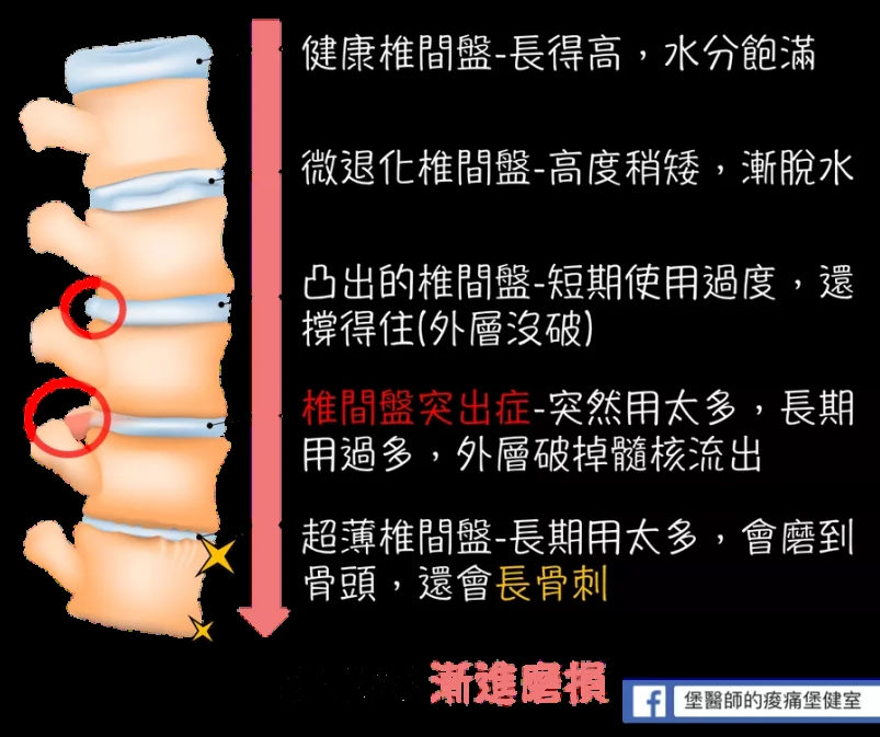 椎間盤退化過程