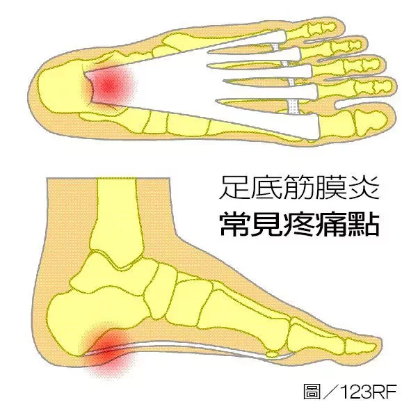 【健康】先別急著積極治療！治足底筋膜炎 釐清原因為首要