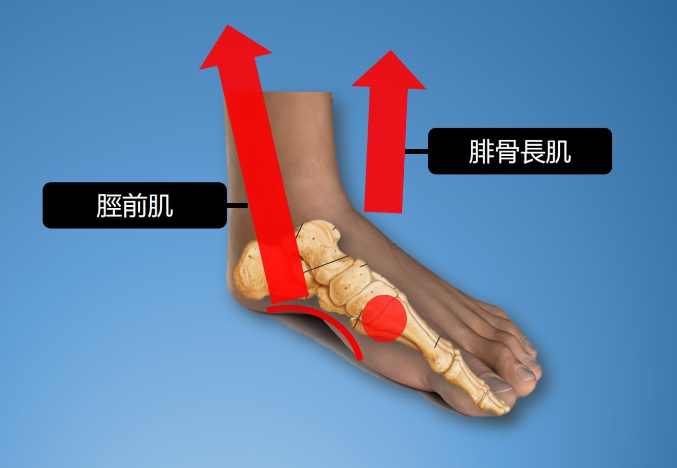 足弓拉扯.jpg